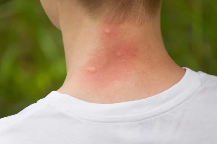 mosquito bite on neck