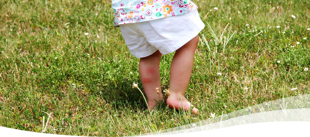 child with chigger bites in grass