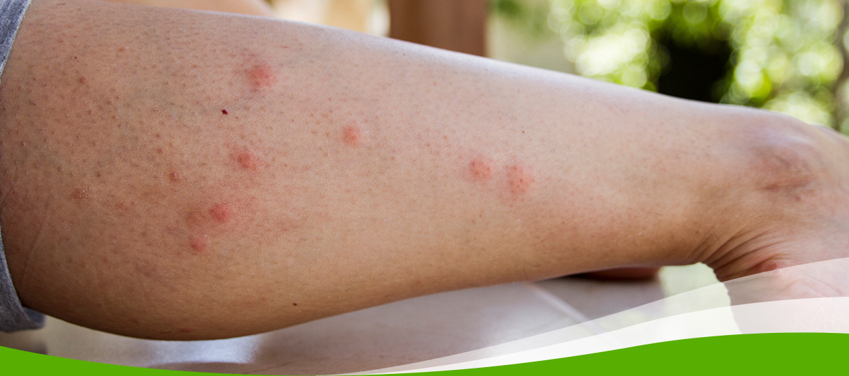 human arm with multiple bug bites